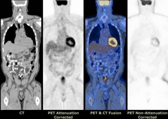 PET-CT