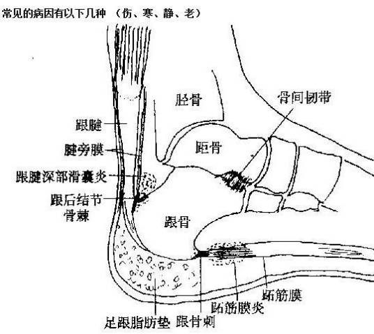 跟痛症