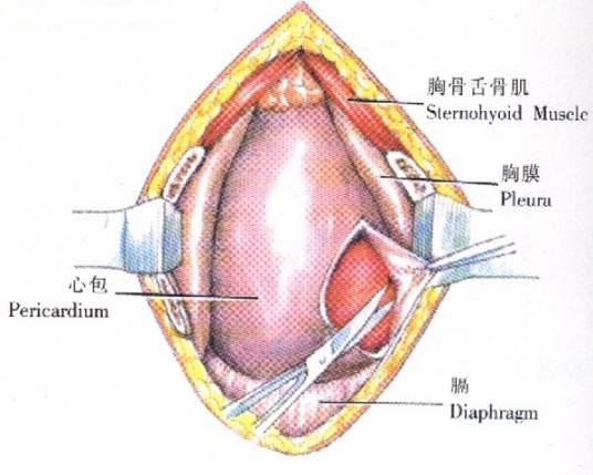 心包穿刺