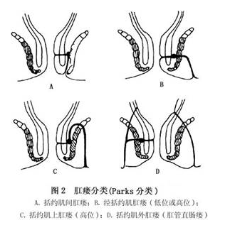 单纯性肛瘘