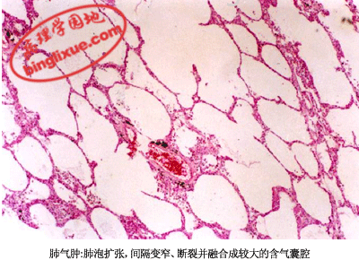 水性肺气肿