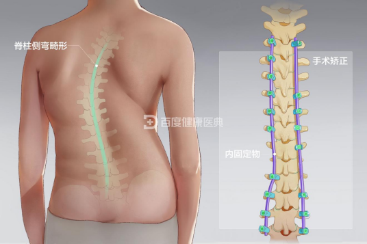 脊柱侧凸