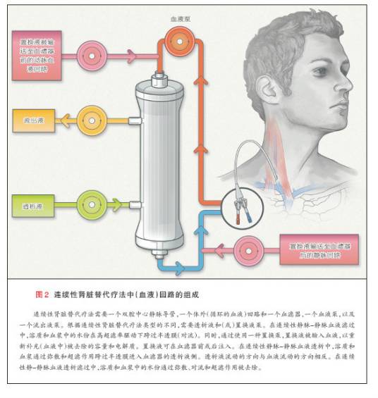 连续肾脏替代疗法