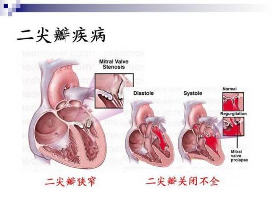 先天性心脏瓣膜病