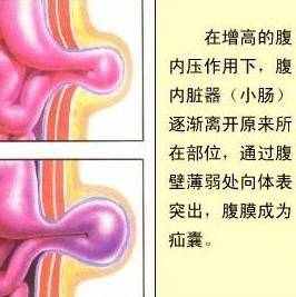 小疝气