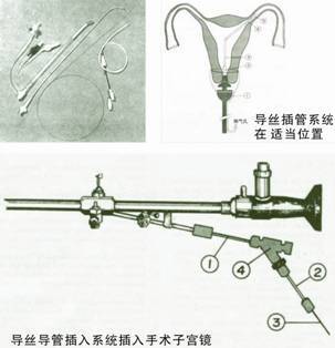 美国COOK输卵管导丝介入术