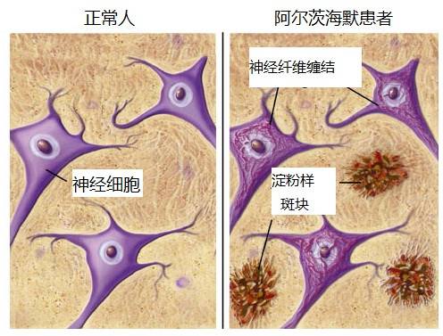 概说阿尔茨海默症