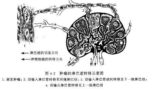 淋巴道转移